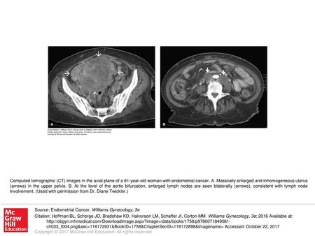 Computed tomographic (CT) images in the axial plane of a 61-year-old woman with endometrial cancer. A. Massively enlarged and inhomogeneous uterus (arrows)
