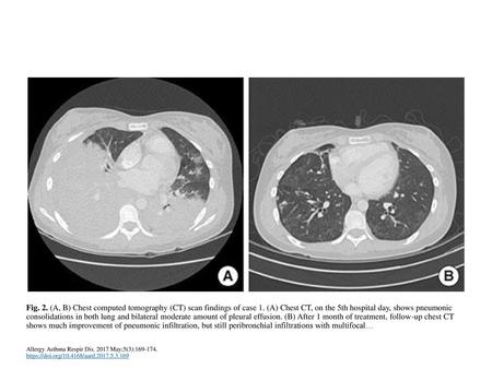 Fig. 2. (A, B) Chest computed tomography (CT) scan findings of case 1