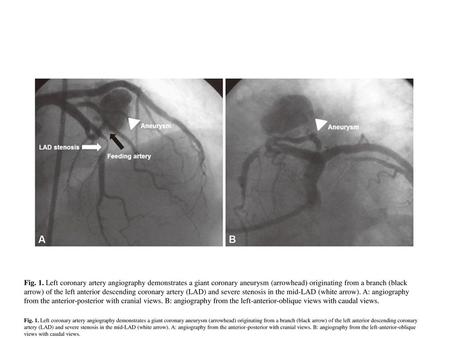 Fig. 1. Left coronary artery angiography demonstrates a giant coronary aneurysm (arrowhead) originating from a branch (black arrow) of the left anterior.