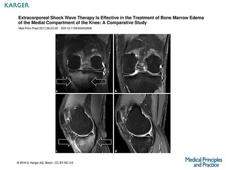 Extracorporeal Shock Wave Therapy Is Effective in the Treatment of Bone Marrow Edema of the Medial Compartment of the Knee: A Comparative Study Med Princ.
