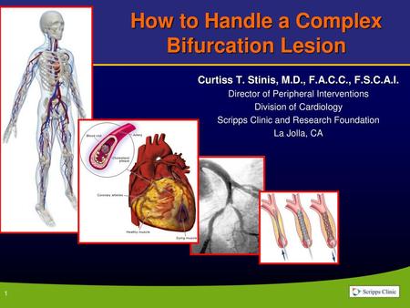 How to Handle a Complex Bifurcation Lesion