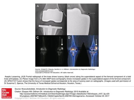 Aseptic Loosening. (A,B) Frontal radiograph of the knee shows lucency (black arrow) along the superolateral aspect of the femoral component of a total.
