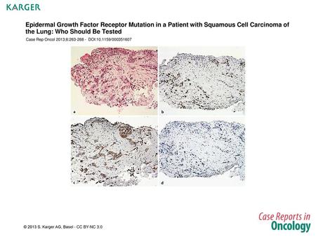Epidermal Growth Factor Receptor Mutation in a Patient with Squamous Cell Carcinoma of the Lung: Who Should Be Tested Case Rep Oncol 2013;6:263-268 -