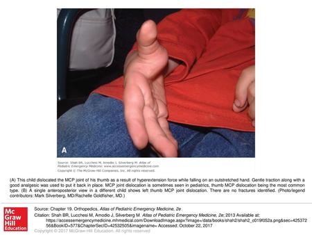 (A) This child dislocated the MCP joint of his thumb as a result of hyperextension force while falling on an outstretched hand. Gentle traction along with.