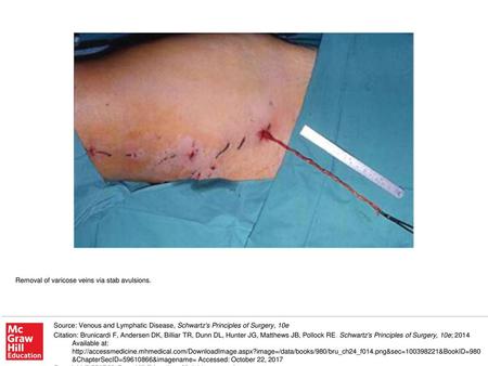 Removal of varicose veins via stab avulsions.