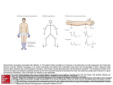 C. Nerve conduction studies demonstrate changes characteristic of an axonal neuropathy. When the ulnar nerve is stimulated above the elbow or at the wrist,