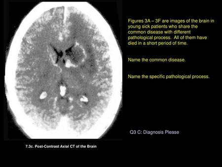 7.3c. Post-Contrast Axial CT of the Brain