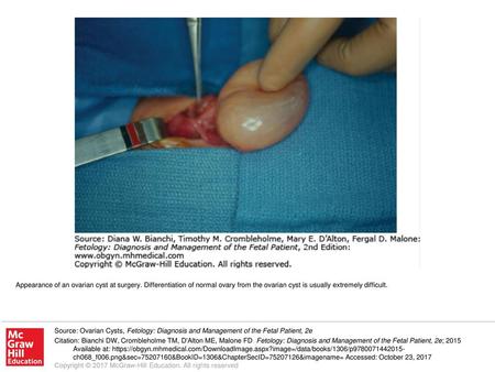 Appearance of an ovarian cyst at surgery