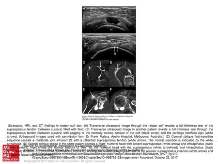 Ultrasound, MRI, and CT findings in rotator cuff tear