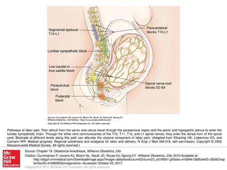 Pathways of labor pain. Pain stimuli from the cervix and uterus travel through the paracervical region and the pelvic and hypogastric plexus to enter the.