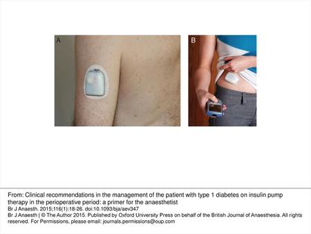 Fig. 1 Examples of Insulin pump systems