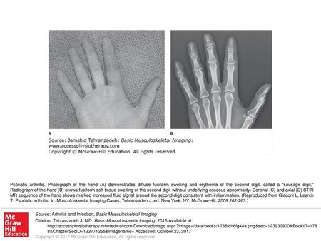 Psoriatic arthritis. Photograph of the hand (A) demonstrates diffuse fusiform swelling and erythema of the second digit, called a “sausage digit.” Radiograph.