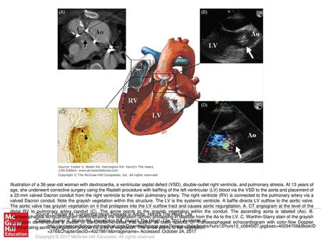 Illustration of a 36-year-old woman with dextrocardia, a ventricular septal defect (VSD), double-outlet right ventricle, and pulmonary atresia. At 13 years.