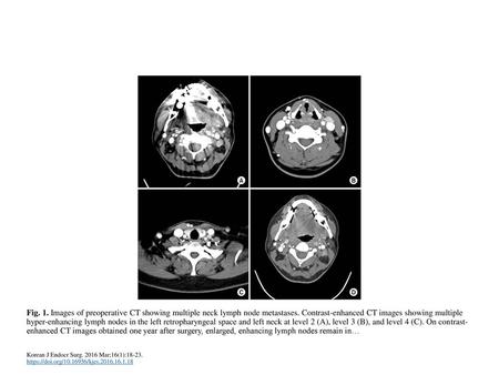 Fig. 1. Images of preoperative CT showing multiple neck lymph node metastases. Contrast-enhanced CT images showing multiple hyper-enhancing lymph nodes.