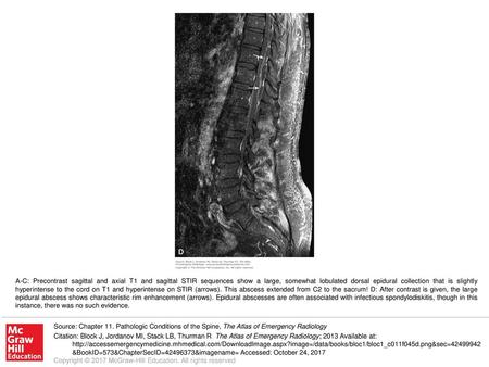 A-C: Precontrast sagittal and axial T1 and sagittal STIR sequences show a large, somewhat lobulated dorsal epidural collection that is slightly hyperintense.
