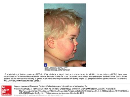 Characteristics of Hunter syndrome (MPS-II)