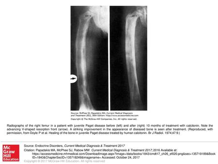 Radiographs of the right femur in a patient with juvenile Paget disease before (left) and after (right) 10 months of treatment with calcitonin. Note the.
