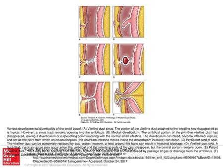 Various developmental diverticulitis of the small bowel