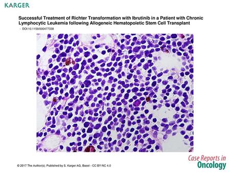 Successful Treatment of Richter Transformation with Ibrutinib in a Patient with Chronic Lymphocytic Leukemia following Allogeneic Hematopoietic Stem Cell.