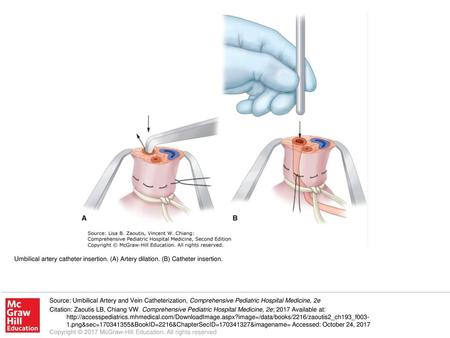 Umbilical artery catheter insertion. (A) Artery dilation