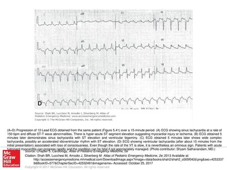 (A–D) Progression of 12-Lead ECG obtained from the same patient (Figure 5.41) over a 15-minute period. (A) ECG showing sinus tachycardia at a rate of 150.