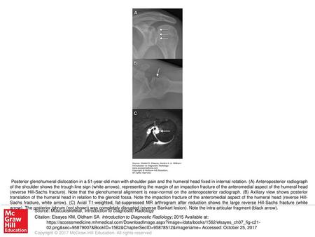 Posterior glenohumeral dislocation in a 51-year-old man with shoulder pain and the humeral head fixed in internal rotation. (A) Anteroposterior radiograph.