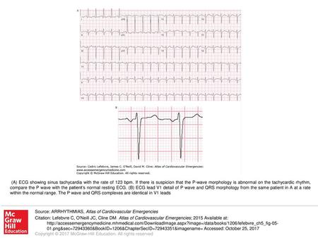 (A) ECG showing sinus tachycardia with the rate of 123 bpm