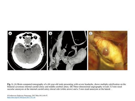Fig. 1. (A) Brain computed tomography of a 64-year-old male presenting with severe headache, shows multiple calcification on the bilateral cavernous internal.