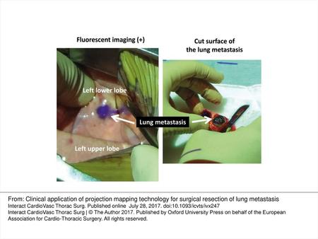 Figure 2: The Medical Imaging Projection System projecting the real-time fluorescent image on the surface of the lung during surgery (left). The cut surface.