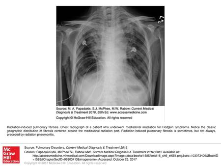 Radiation-induced pulmonary fibrosis