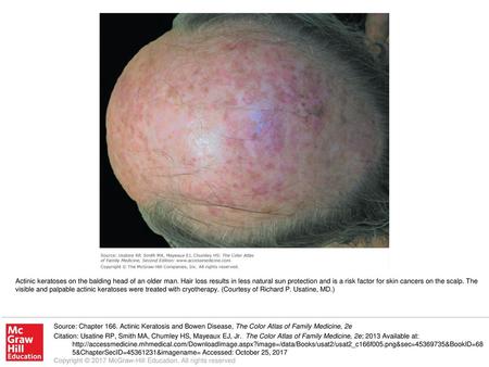 Actinic keratoses on the balding head of an older man