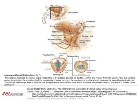 This diagram illustrates the normal spatial relationship of the prostate gland to the bladder, urethra, and rectum. From the bladder neck, the prostatic.