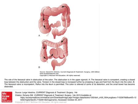 The role of the ileocecal valve in obstruction of the colon