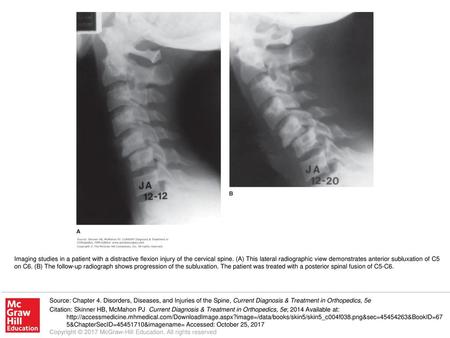 Imaging studies in a patient with a distractive flexion injury of the cervical spine. (A) This lateral radiographic view demonstrates anterior subluxation.