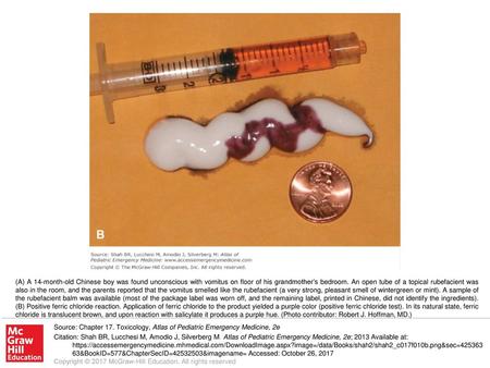 (A) A 14-month-old Chinese boy was found unconscious with vomitus on floor of his grandmother’s bedroom. An open tube of a topical rubefacient was also.