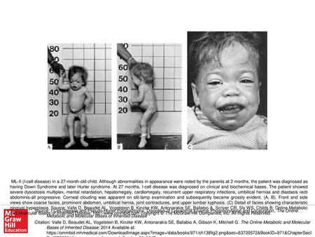 ML-II (I-cell disease) in a 27-month-old child