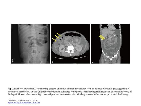 Fig. 2. (A) Erect abdominal X-ray showing gaseous distention of small bowel loops with an absence of colonic gas, suggestive of mechanical obstruction.