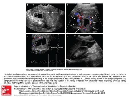 Multiple transabdominal and transvaginal ultrasound images of a different patient with an ectopic pregnancy demonstrating (A) echogenic debris in the endometrial.