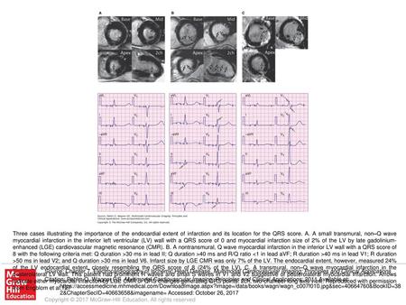 Three cases illustrating the importance of the endocardial extent of infarction and its location for the QRS score. A. A small transmural, non–Q wave myocardial.
