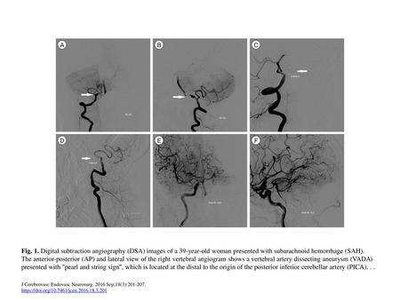 Fig. 1. Digital subtraction angiography (DSA) images of a 39-year-old woman presented with subarachnoid hemorrhage (SAH). The anterior-posterior (AP) and.