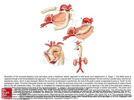 Illustration of the reversed elephant trunk technique using a traditional “island” approach to total aortic arch replacement. A. Stage 1: The distal aorta.