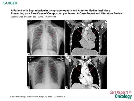 A Patient with Supraclavicular Lymphadenopathy and Anterior Mediastinal Mass Presenting as a Rare Case of Composite Lymphoma: A Case Report and Literature.