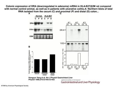 Colonic expression of DRA (downregulated in adenoma) mRNA in HLA-B27/β2M rat compared with normal control animal, as well as in patients with ulcerative.