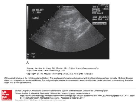 (A) Longitudinal view of the right transplanted kidney