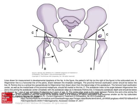 Lines drawn for measurement in developmental dysplasia of the hip