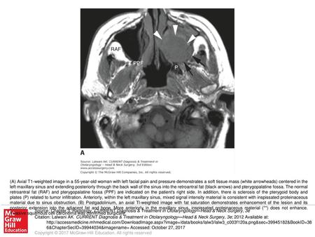 (A) Axial T1-weighted image in a 55-year-old woman with left facial pain and pressure demonstrates a soft tissue mass (white arrowheads) centered in the.