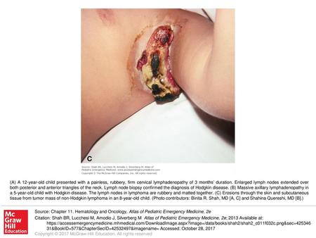 (A) A 12-year-old child presented with a painless, rubbery, firm cervical lymphadenopathy of 3 months’ duration. Enlarged lymph nodes extended over both.