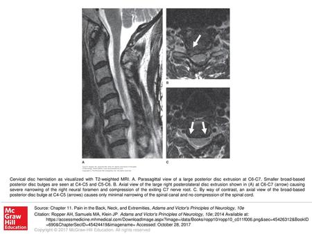 Cervical disc herniation as visualized with T2-weighted MRI. A