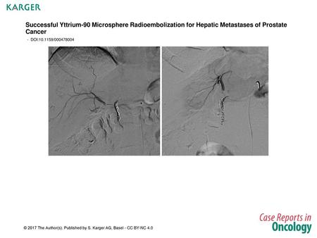 Successful Yttrium-90 Microsphere Radioembolization for Hepatic Metastases of Prostate Cancer - DOI:10.1159/000478004 Fig. 1. Embolisation of the right.