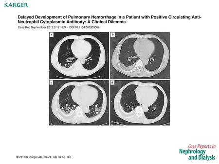 Delayed Development of Pulmonary Hemorrhage in a Patient with Positive Circulating Anti-Neutrophil Cytoplasmic Antibody: A Clinical Dilemma Case Rep Nephrol.
